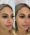 With the help of these sessions of Liquid nose job Beverly Hills, you will be able to achieve the results you want so much in a short time.